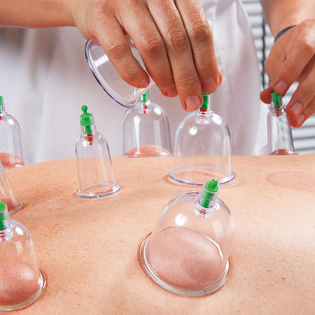 cupping