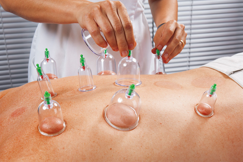 cupping treatment